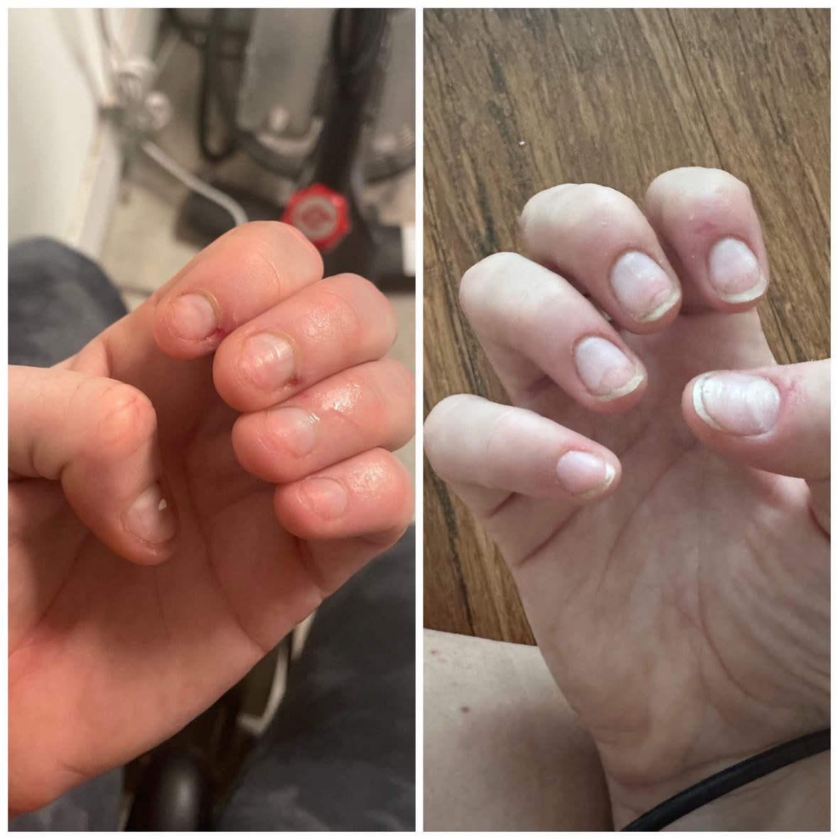 Small healed Kambo gate points on the skin of a hand — the tiny dots where the medicine enters